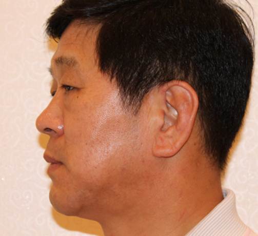 시술 8일 후